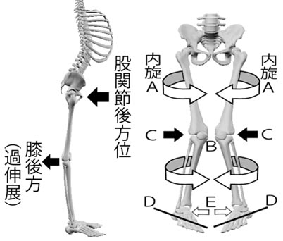 内股矯正で改善ストレッチ体操6選 歩き方や立ち姿勢までキレイになる美脚エクササイズ 三豊 観音寺の整体 きたの均整院 産後骨盤矯正 腰痛 肩こり 猫背 スポーツ整体